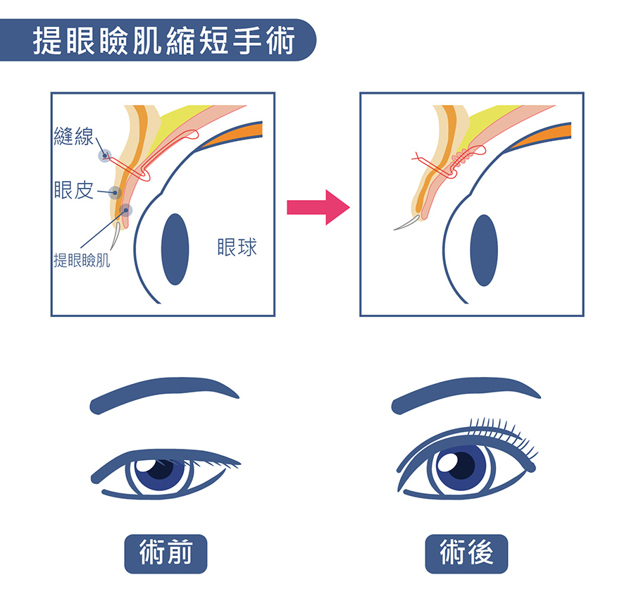 提眼臉肌無力