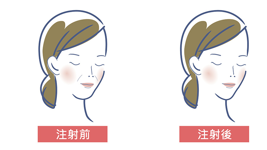玻尿酸注射前後