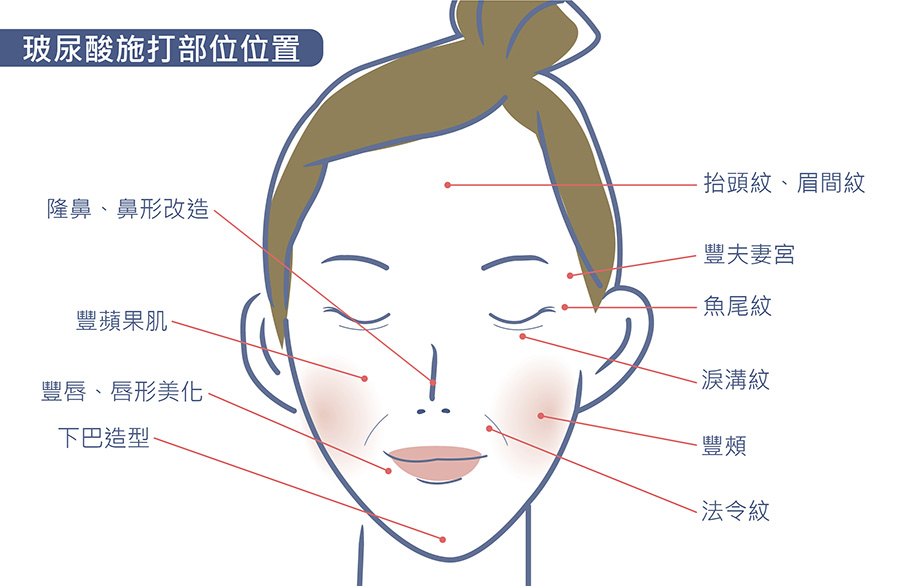 玻尿酸施打部位位置