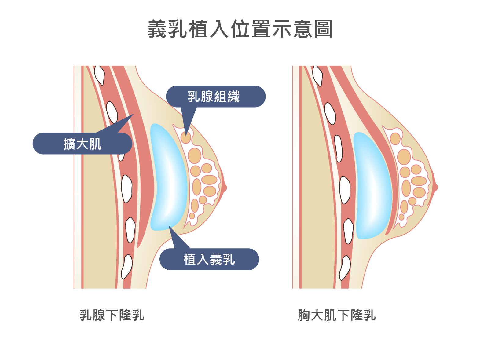 義乳植入位置示意圖