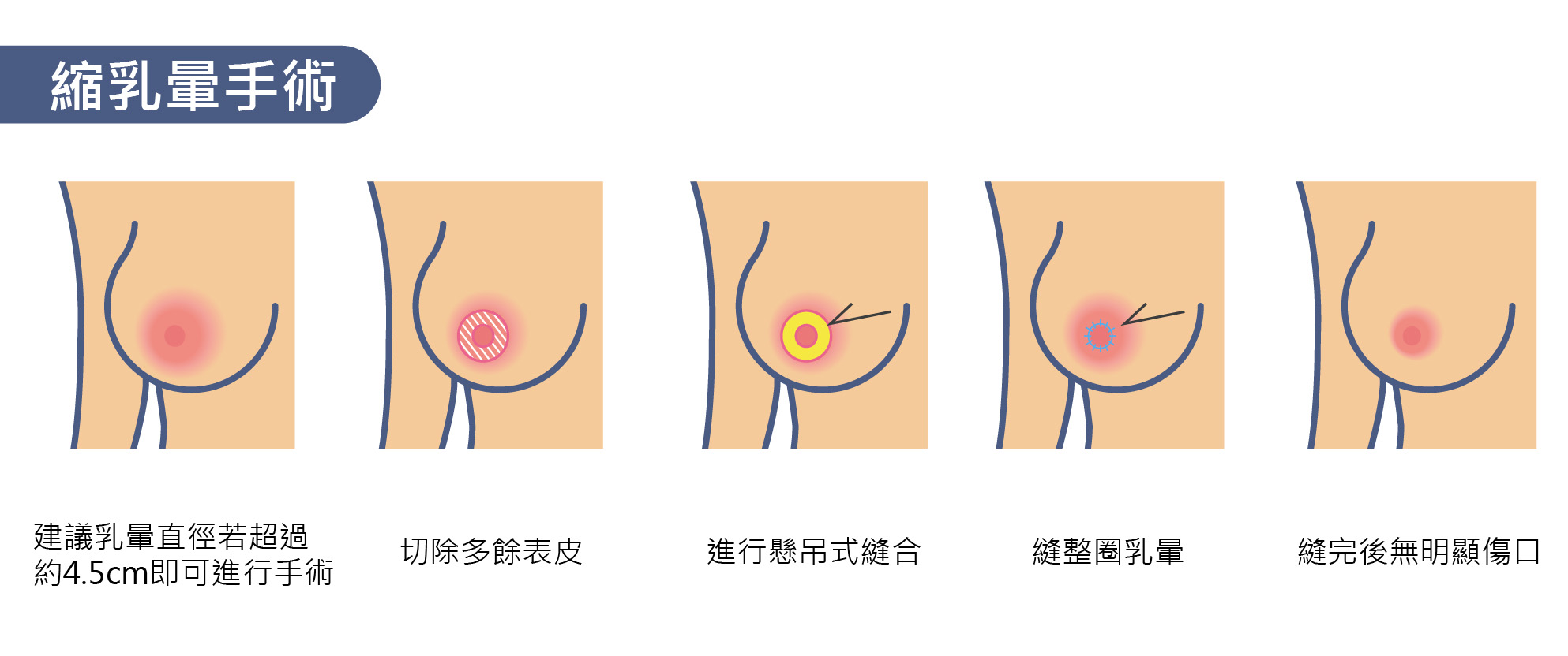 乳暈整形手術