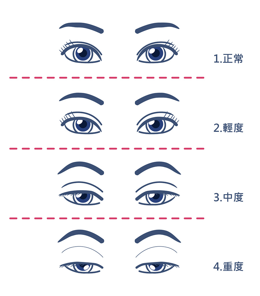 上眼皮鬆弛下垂