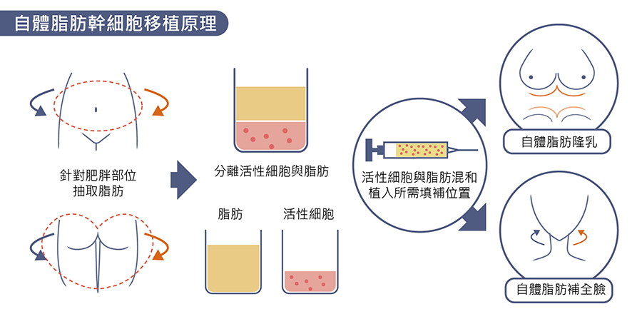 自體脂肪幹細胞移植原理