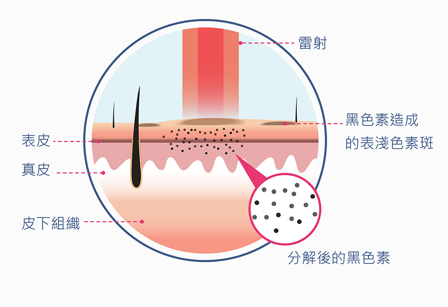 光纖美白雷射除斑作用原理