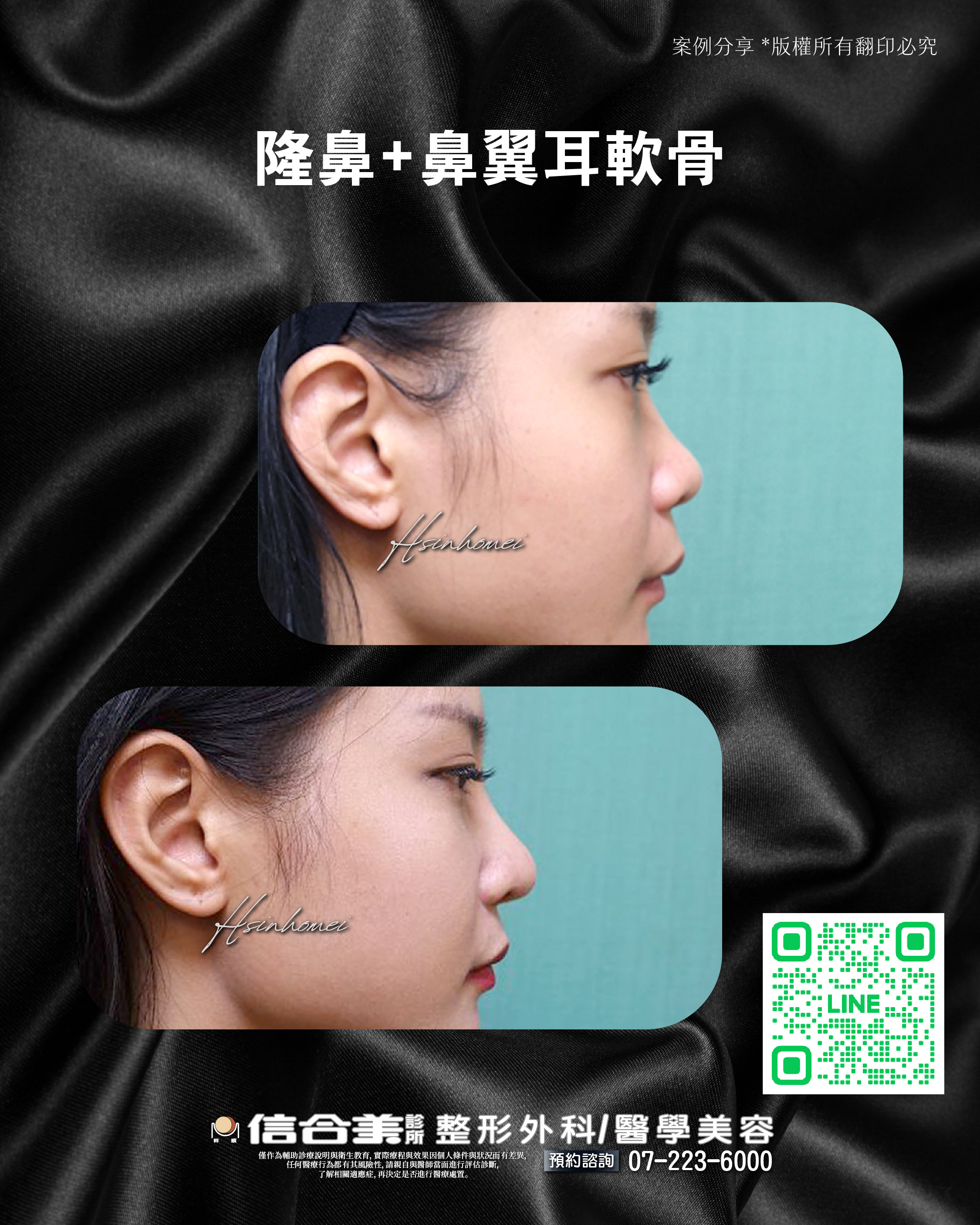 隆鼻案例