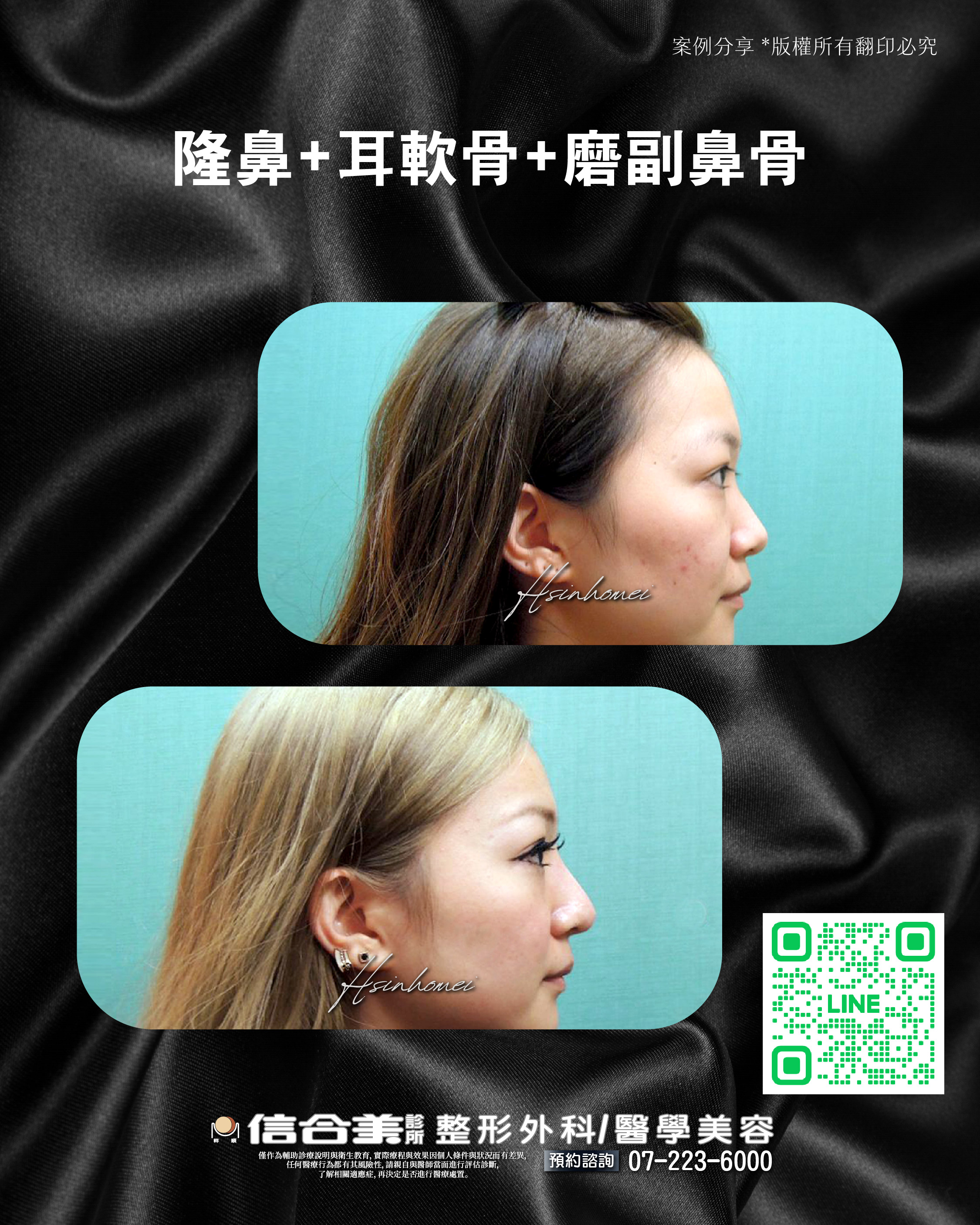 隆鼻案例