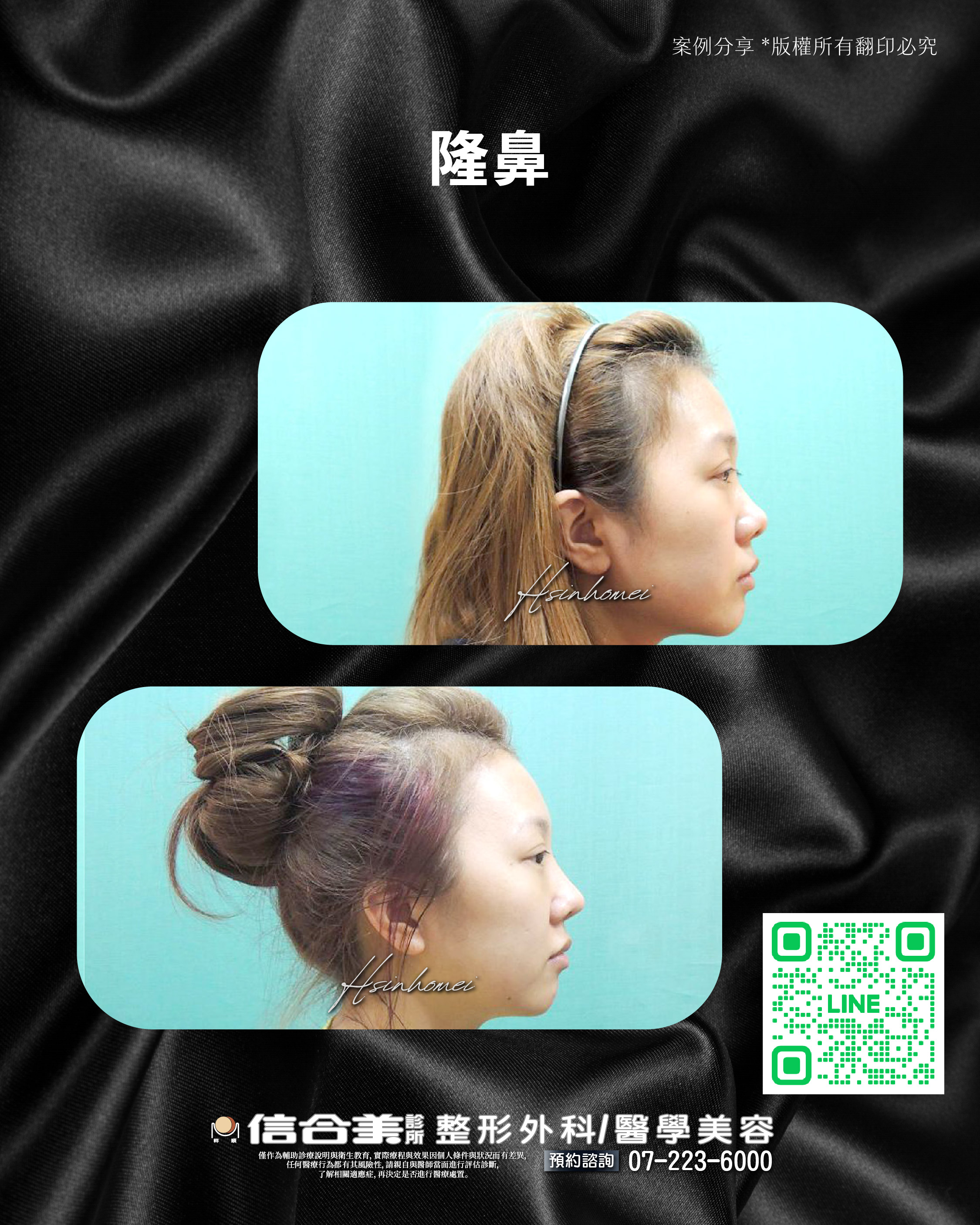 隆鼻案例