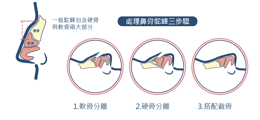 鼻骨駝峰整形