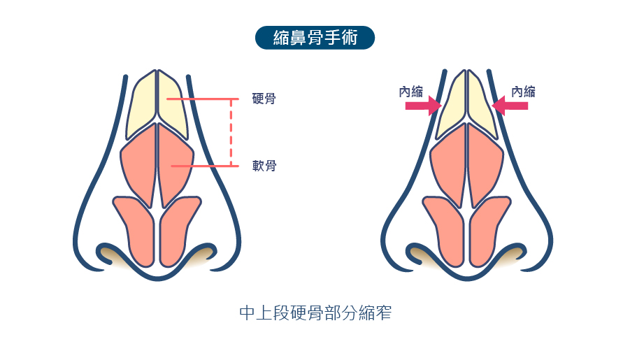 縮鼻骨整形