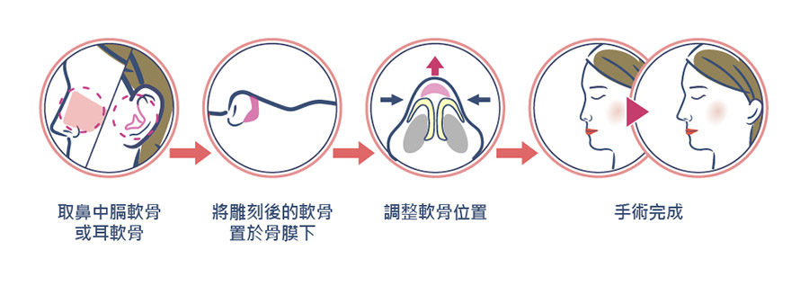 自體耳軟骨隆鼻