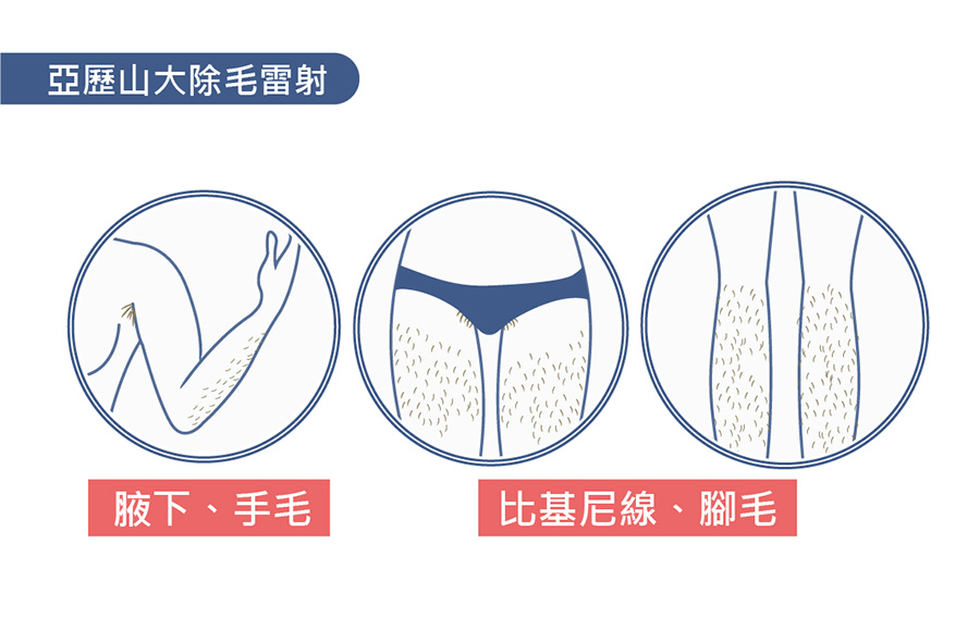 亞歷山大除毛雷射