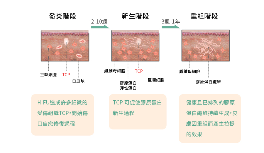 音波拉提