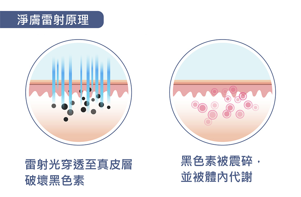 淨膚雷射原理